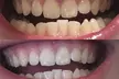 Up to 64% Off on Teeth Whitening - Traditional at Better bodies - Image 3
