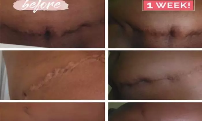 Up to 20% Off on Brazilian Stretch Mark Camouflage at Body Goals Sculpting Studio - Primary Image