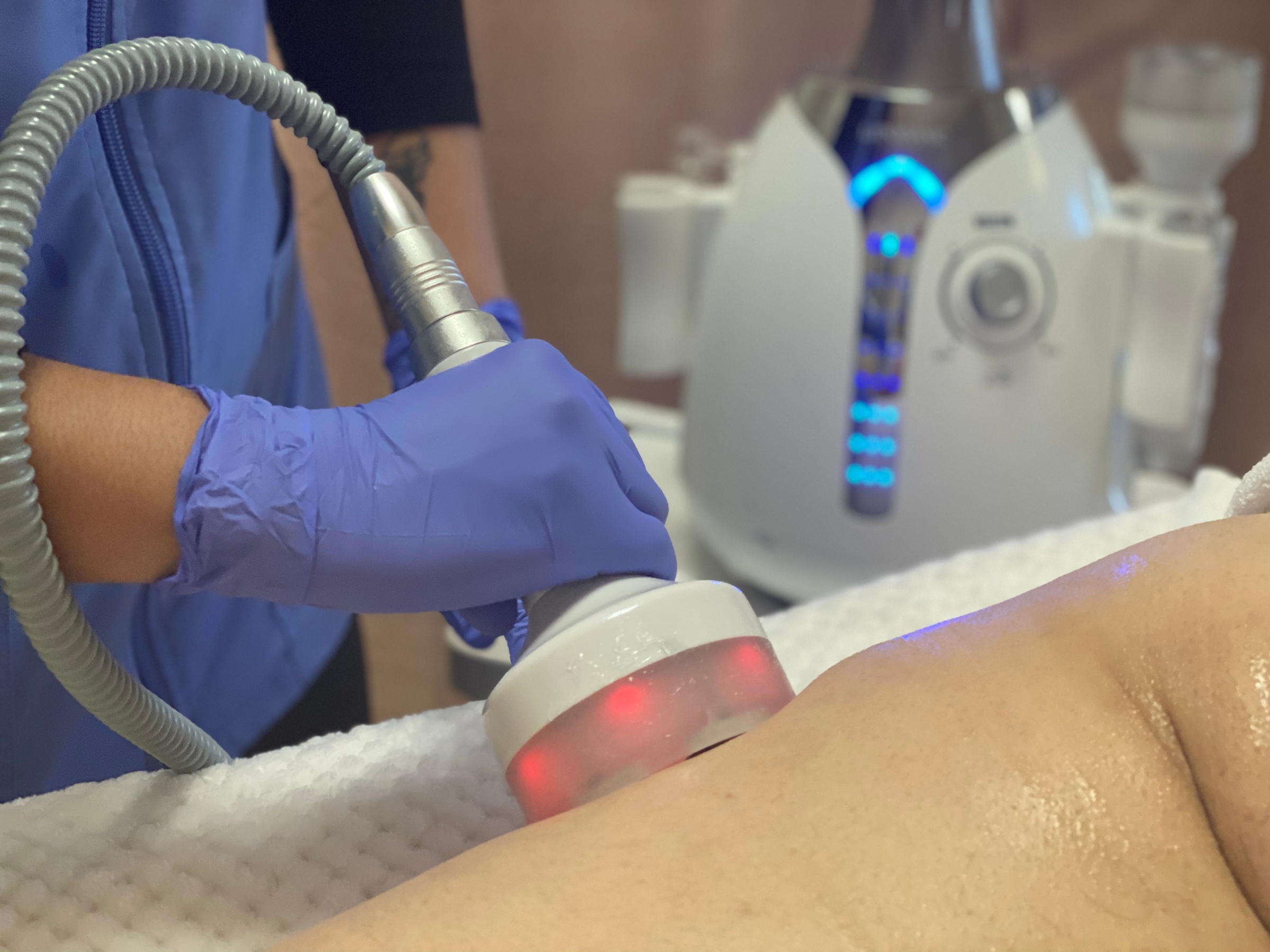 Vacuum RF Cupping for Love Handles, Stomach & Legs