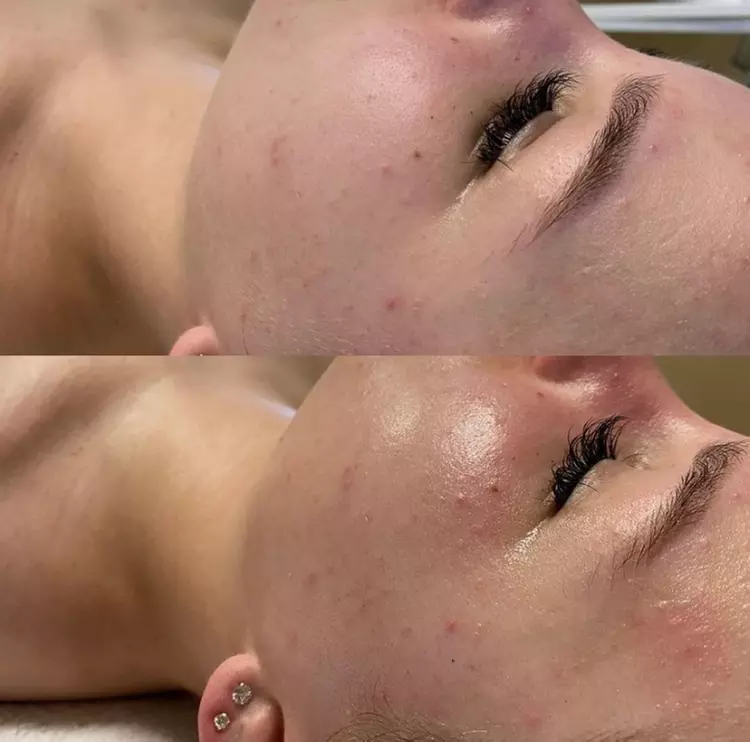 Up to 81% Off on Microdermabrasion at Silver Lining Aesthetics - Primary Image