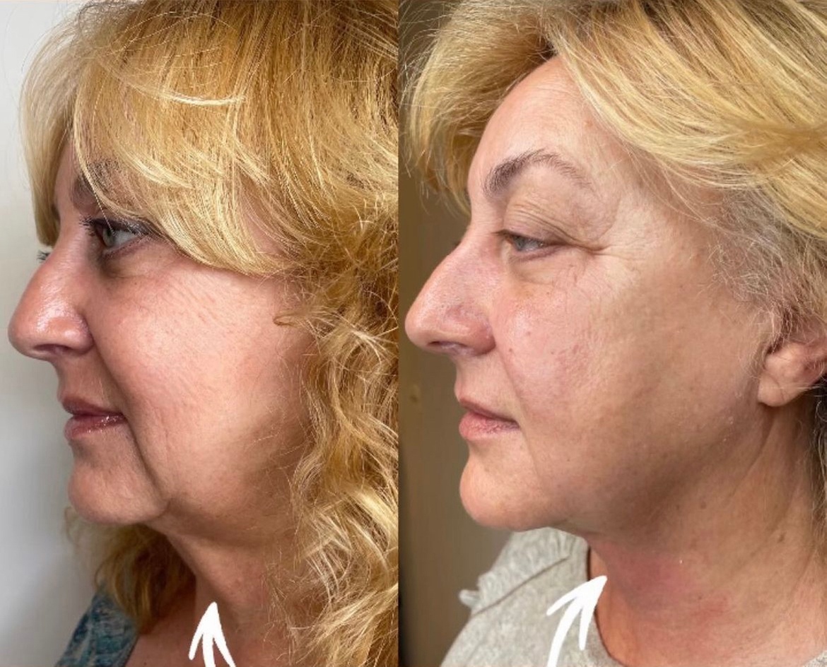 Up to 54% Off on Facelift - Non-Surgical at Dk Med Spa Microblading And Academy - Primary Image