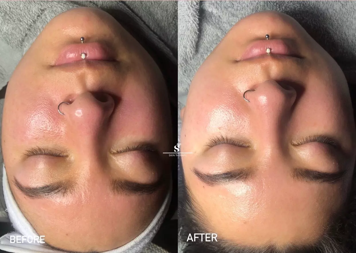 Up to 22% Off on Micro-Needling at Skin Therapy - Primary Image