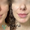 Image 2: Enhance your look with Vivara Med Spa's Revanesse Lip Filler and Versa+ Injections up to 33% off for a radiant appearance