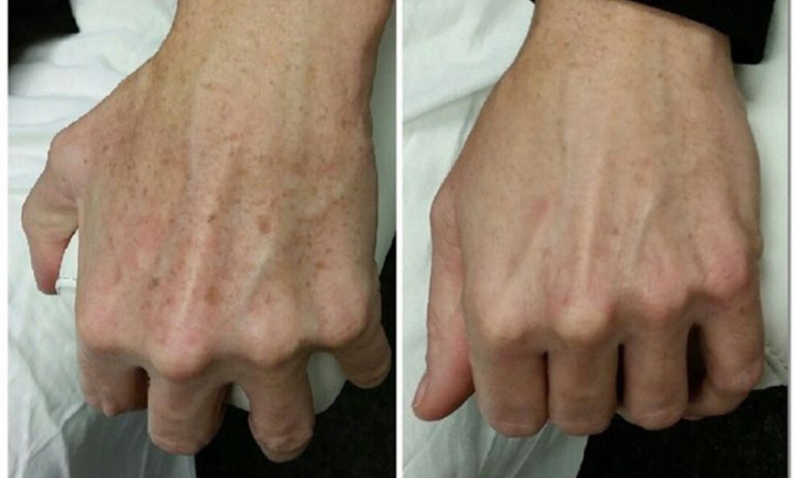 Image 3: Up to 43% Off on IPL-Intense Pulse Light Therapy at Aesthetics Care Med Spa