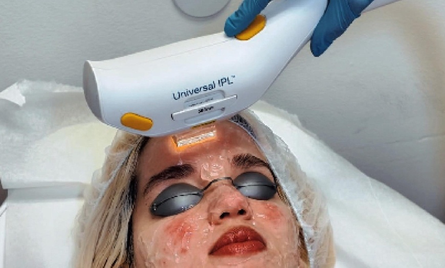 Image 4: Revitalize Your Skin: 1 or 3 IPL Photofacials Sessions at Bye 2 Hair
