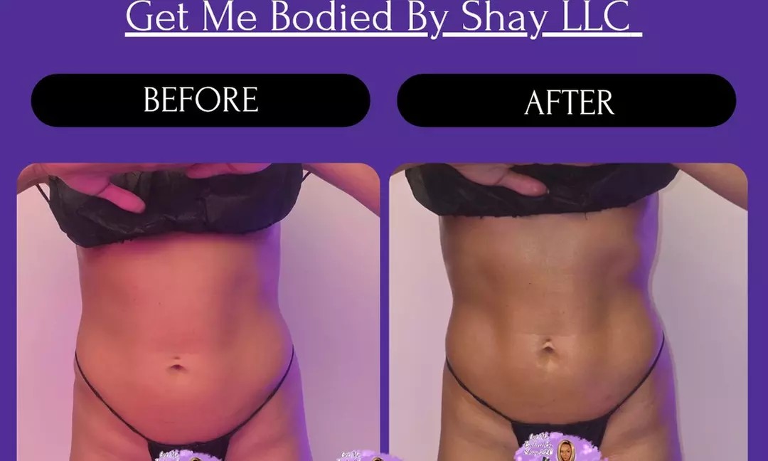 Post-Op Lymphatic Drainage Massages with Optional Wood Therapy