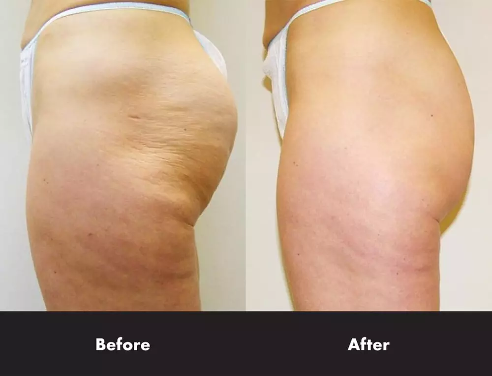 Body Contouring ​at HealthKey MedSpaClubs (Up to54% Off). Four Options Available