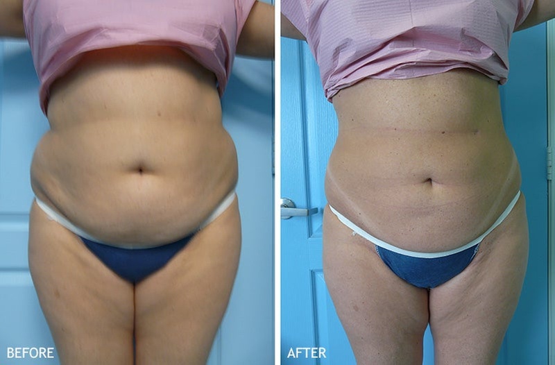 Vaser Liposuction for One Area with Invasive Laser