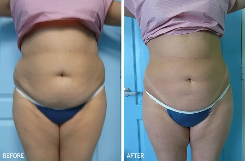 Experience Coastal Dermatology's Vaser Liposuction on One Area with Invasive Laser and save up to 69% - Primary Image