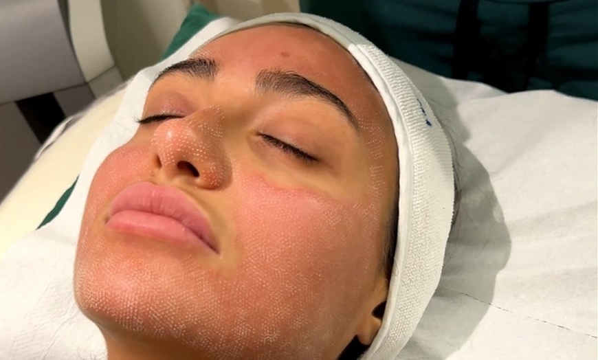 Image 10: Revitalize w/ Pearl Fractional Laser w/ Optional Exosomes (Stem Cells)