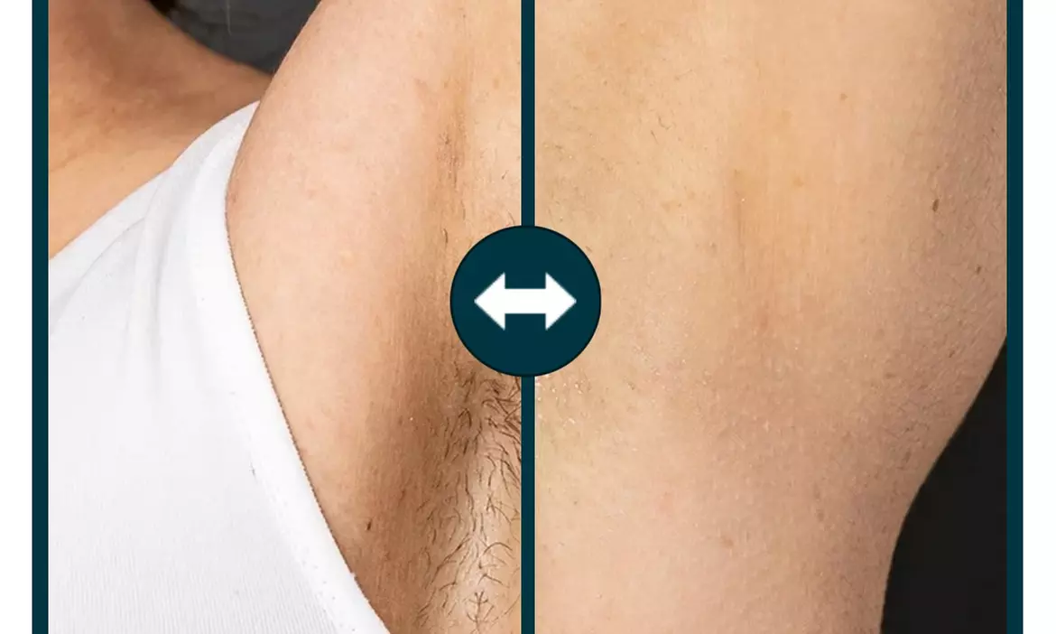 Up to 69% Off on Soprano Laser Hair Removal at Aesthetics Care Med Spa