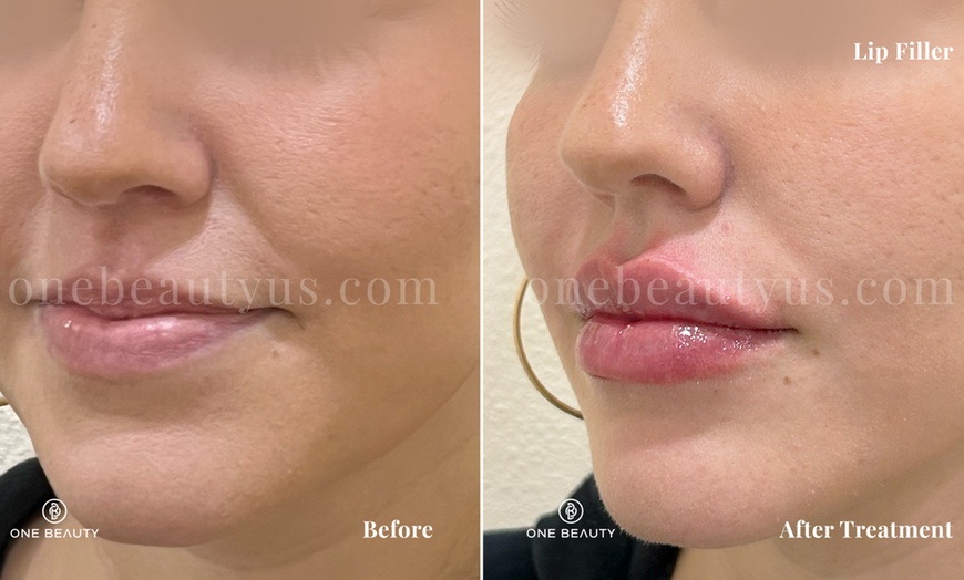 Image 4: Up to 50% Off on Injection - Voluma at One Beauty Aesthetics - Irvine