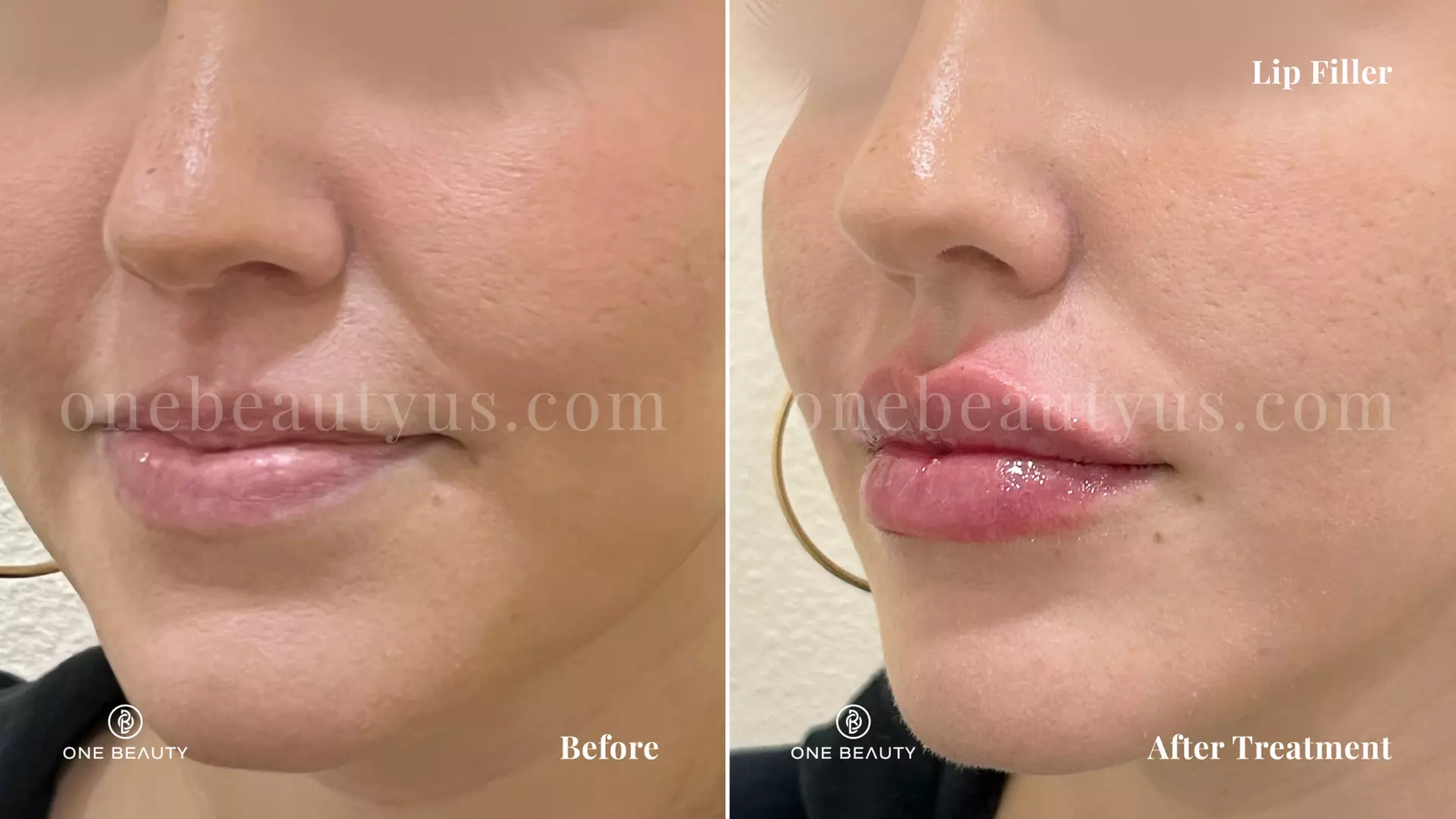 Up to 64% Off on Injection - Voluma at One Beauty Aesthetics - Irvine