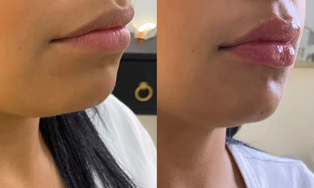Up to 39% Off on Injection - Dermal Filler at Glamour Med Spa And Beauty Bar - Second Medium