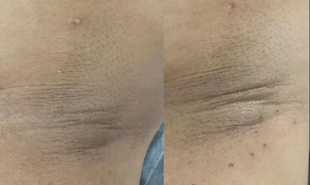 Up to 37% Off on Mole / Growth Removal at Lux Studio - Second Medium
