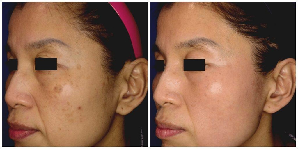 Picosure Laser Treatment for Acne Scars and Pigmentation