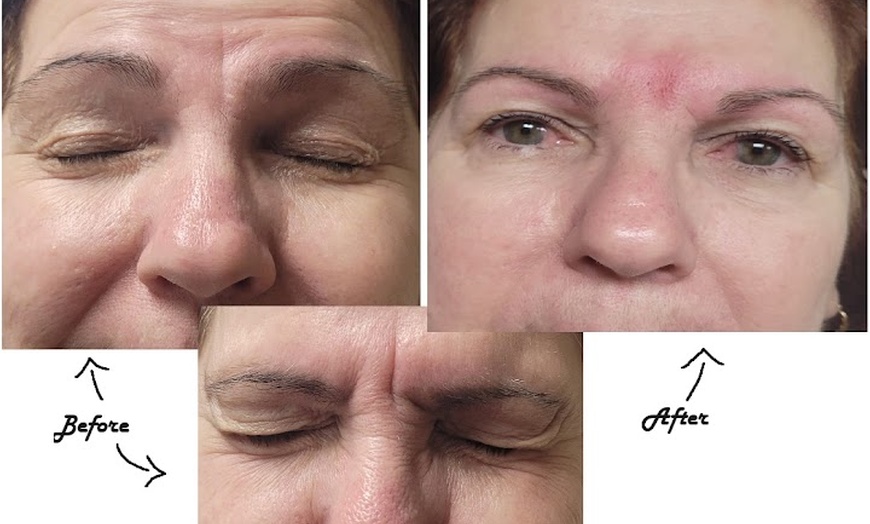 Image 2: Get Refreshed with 20, or 40 Units of Xeomin Injections 