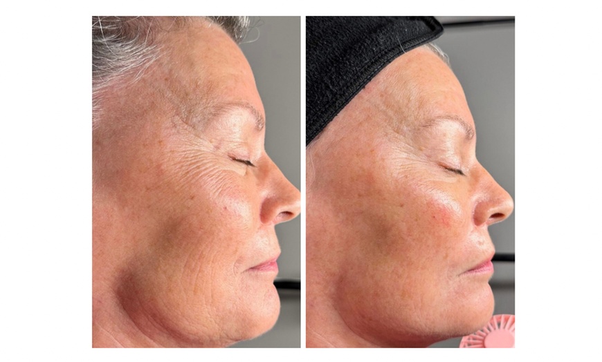 Image 3: Turn Back Time with the Power of BioRePeel at Rise Skin Spa