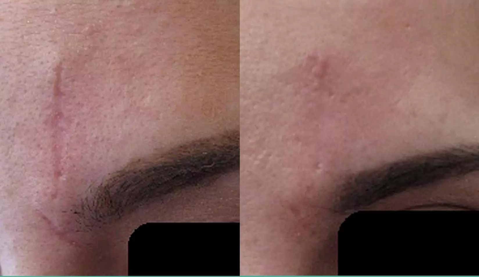 Up to 57% Off on Facial at Laser Center by Jana Bay - Second Medium