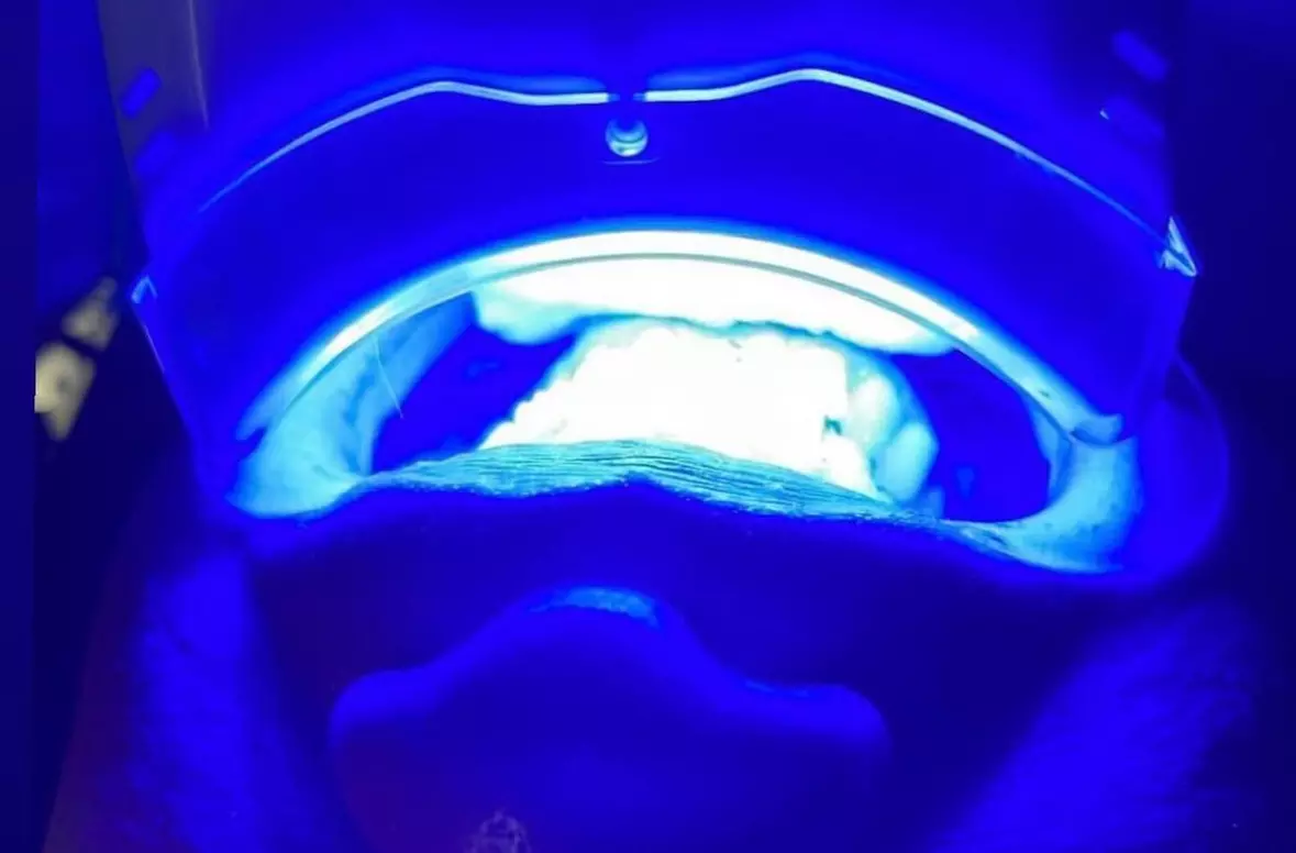 Up to 40% Off on Teeth Whitening - In-Office - Non-Branded at Ursula Versace Aesthetics