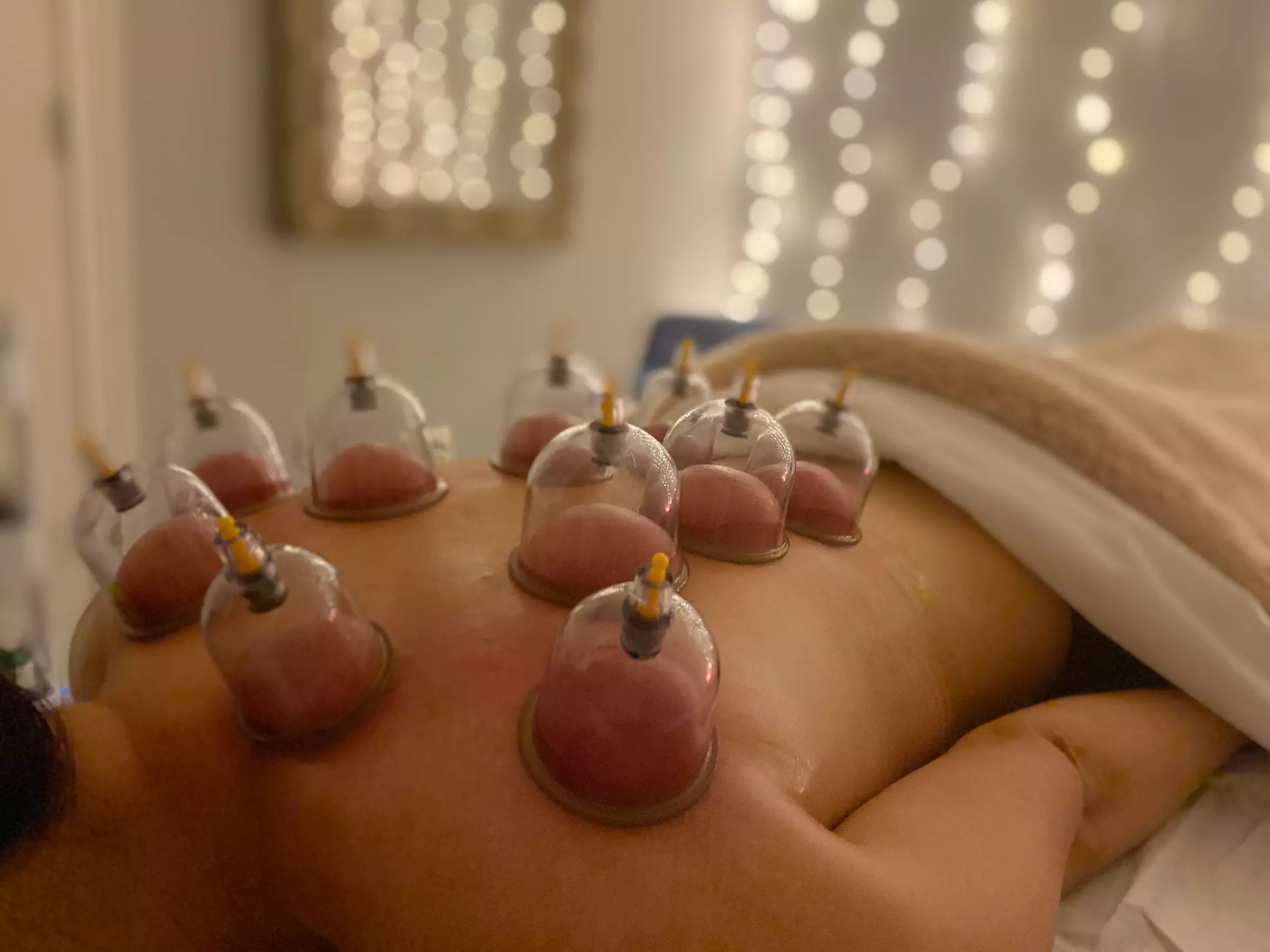 Up to 70% Off on Cupping at Anaheim Wellness Center - Primary Image