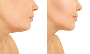 Up to 79% Off on Facelift - Non-Surgical at Tulip Medical Aesthetics