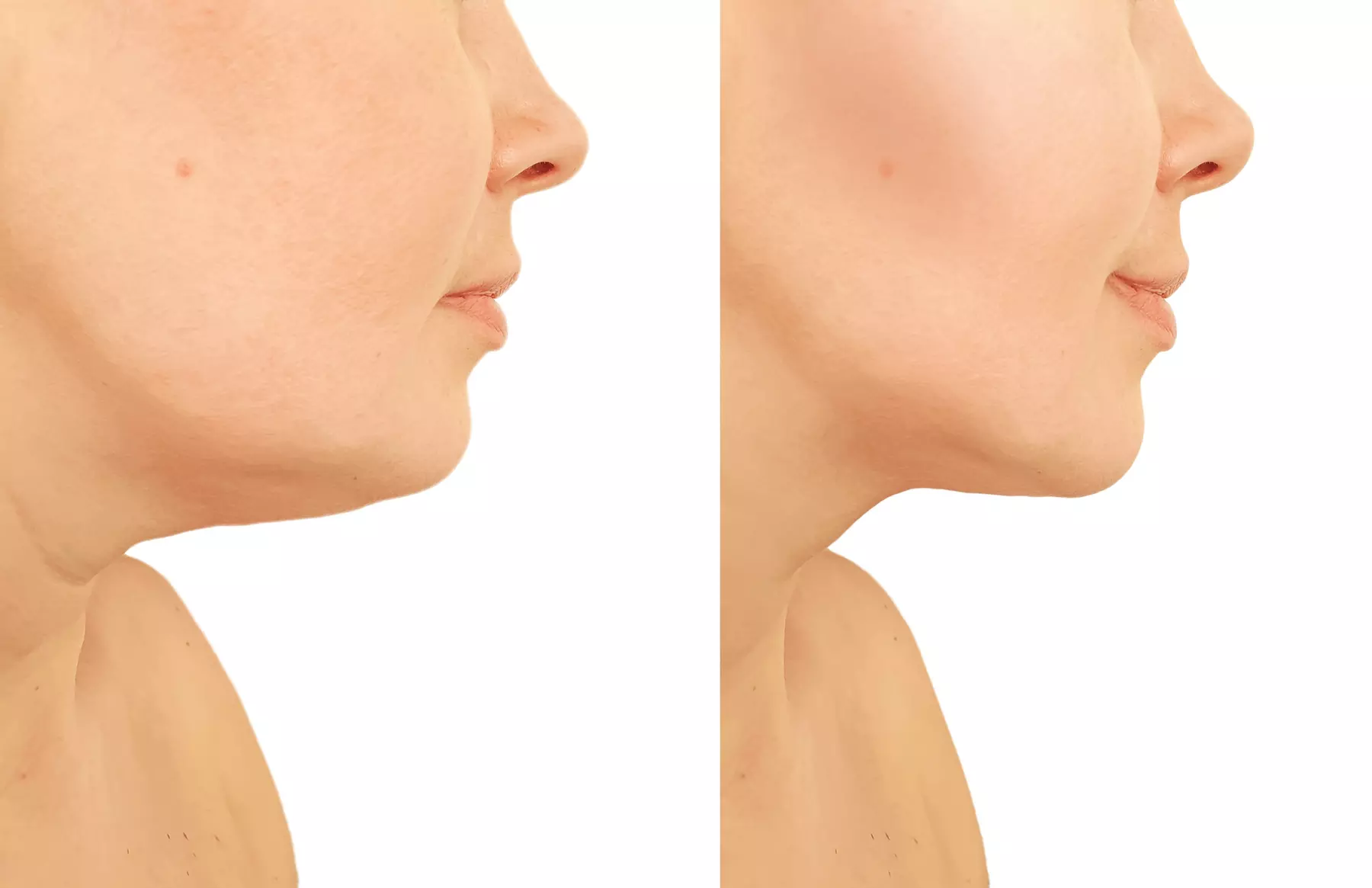 Up to 44% Off on Facelift - Non-Surgical