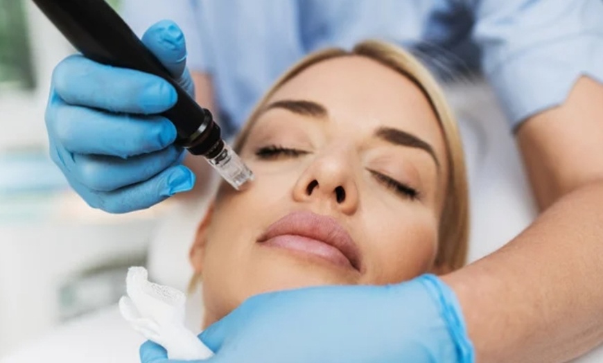 Image 1: Up to 57% Off on Micro-Needling at Abbeywell Therapy