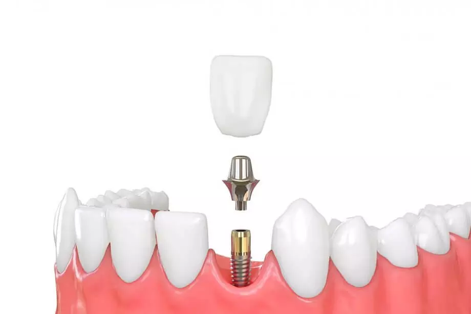 Discover AZ Dental Wellness's porcelain crowns or implants for a new smile with up to 55% off innovative solutions. - Primary Image