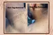 Skin tag removal Up to 34% Off at Regains Beauty & Aesthetics - Image 3
