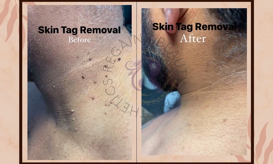 Image 3: Skin Tag Removal: 1 session w/ Wart, Papulosa/Milk Spots or Large Tag