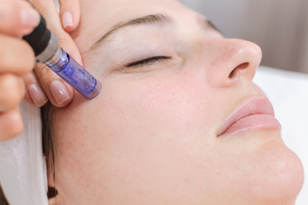 Up to 33% Off on Micro-Needling at Sunflower Beauty Studio
