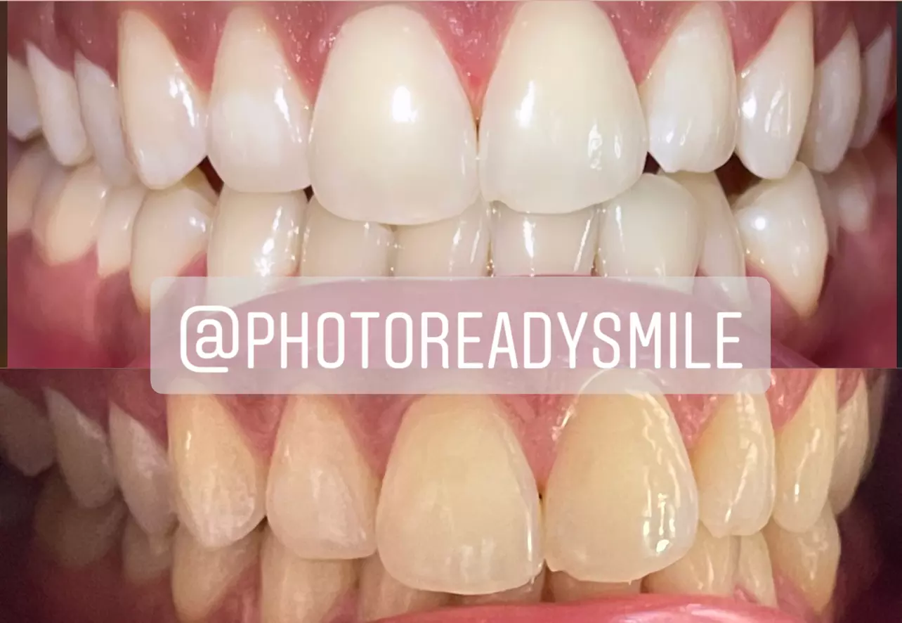 Up to 14% Off on Teeth Whitening at Photo Ready Smile - Second Medium