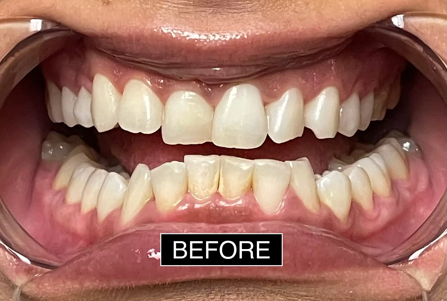 Brighten Your Smile with 30-90 Minute Teeth Whitening Options