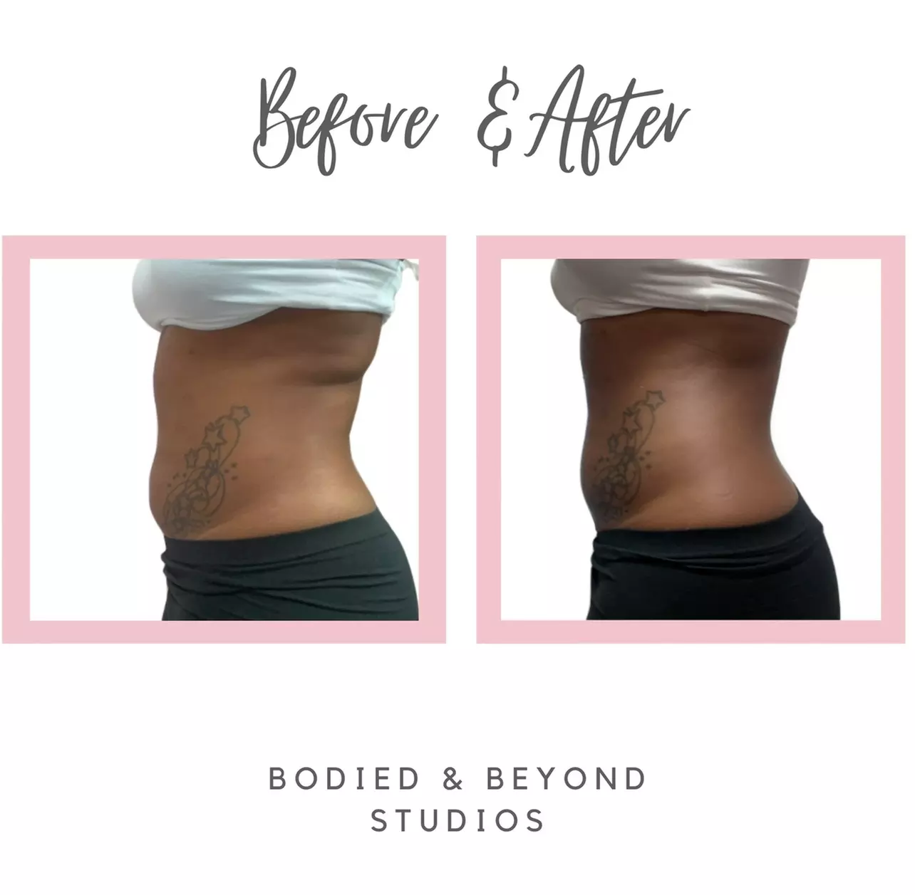 Three Laser-Lipo Sessions with Cavitation Treatments