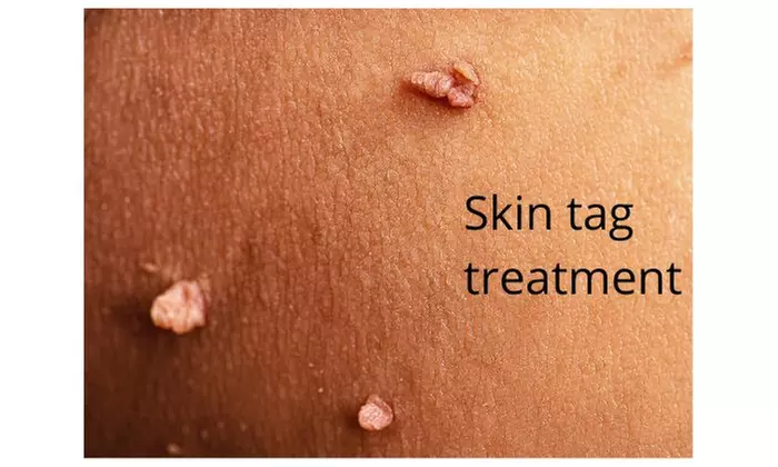 Non-Laser Skin Tag Treatments: 1 or 2 Personalized Options at Topeka Acne Skin Care & Day Spa (Up to 55% Off) - Primary Image