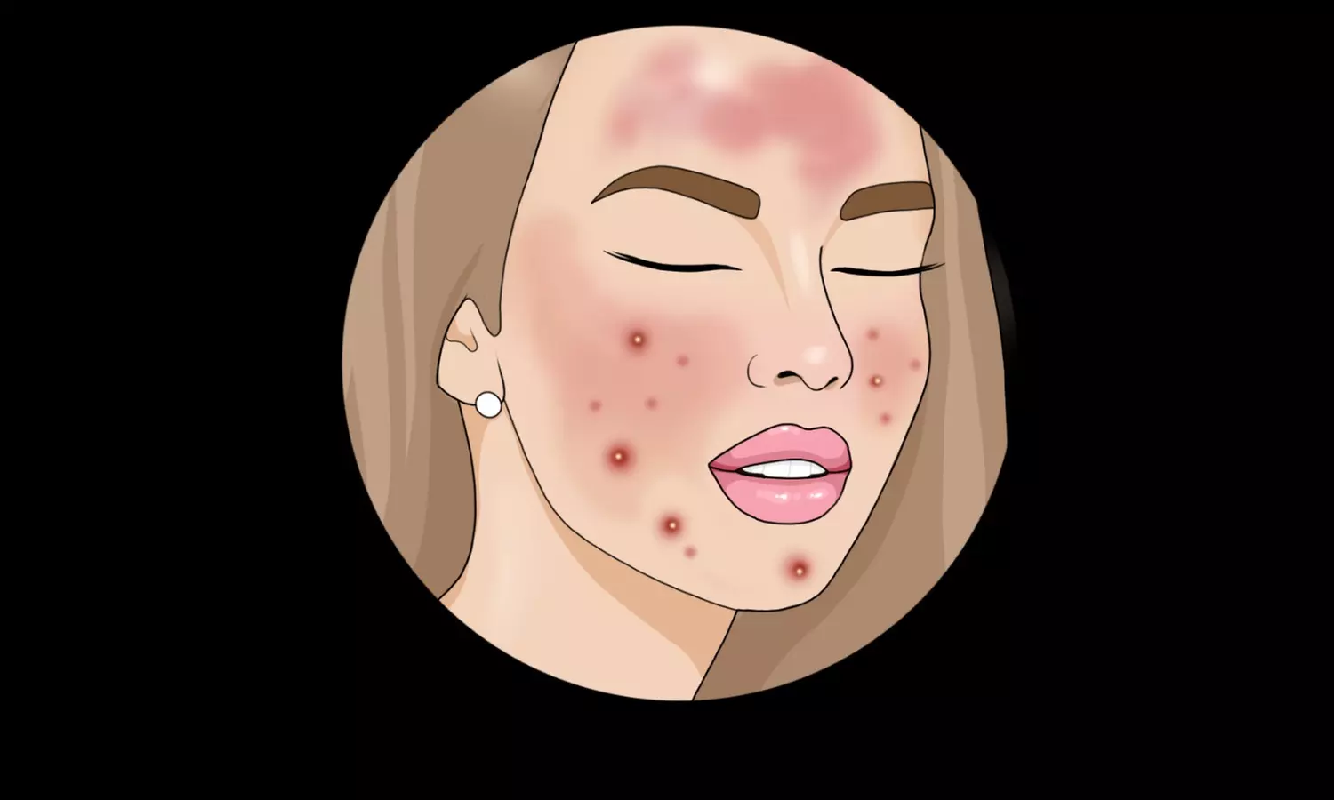 Experience the innovative BioRePeel Chemical Peel at Gentlelase Laser Aesthetics with no downtime, safe for all year use, up to 70% off