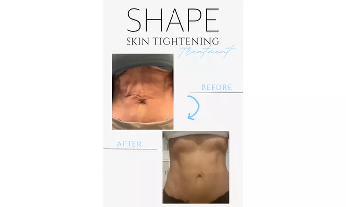 Non-Invasive Skin Tightening Treatments for a Toned Look