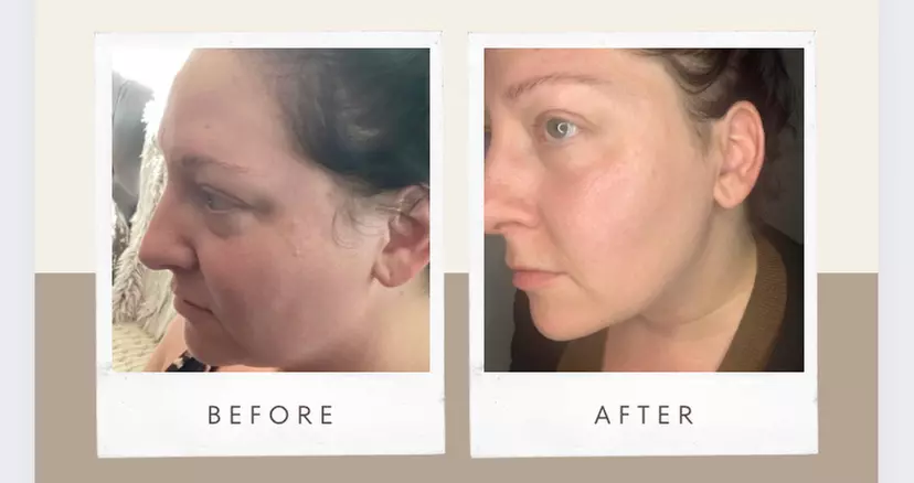 Up to 45% Off on Facelift - Non-Surgical at DeepHaven Rejuvenation - Second Medium