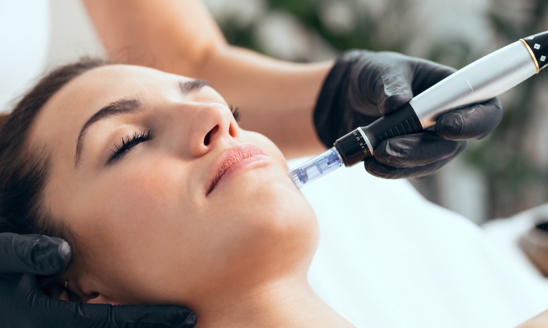 Unleash Radiant Skin: Transform Your Look with Micro-Needling Magic