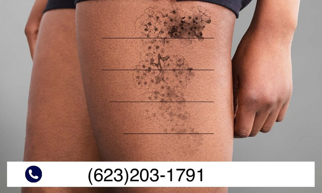 Tattoo-Removal Sessions with Minimal Downtime and Discomfort