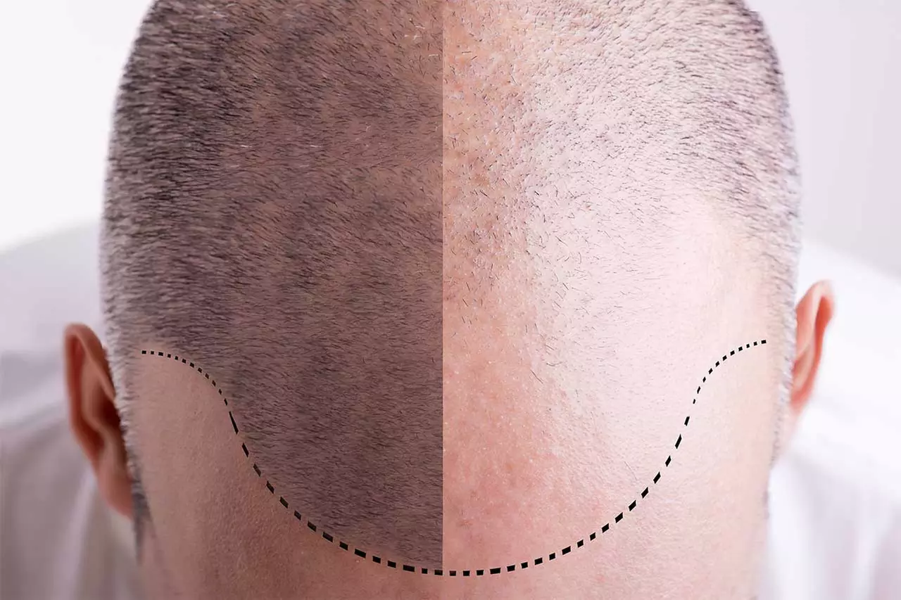 Up to 40% Off on Hair Restoration - Other at HairDox SMP - Primary Image