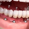 Image 3: Up to 91% Off on Dental Implant / Corona / Veneer at ImplantWIDE Skokie
