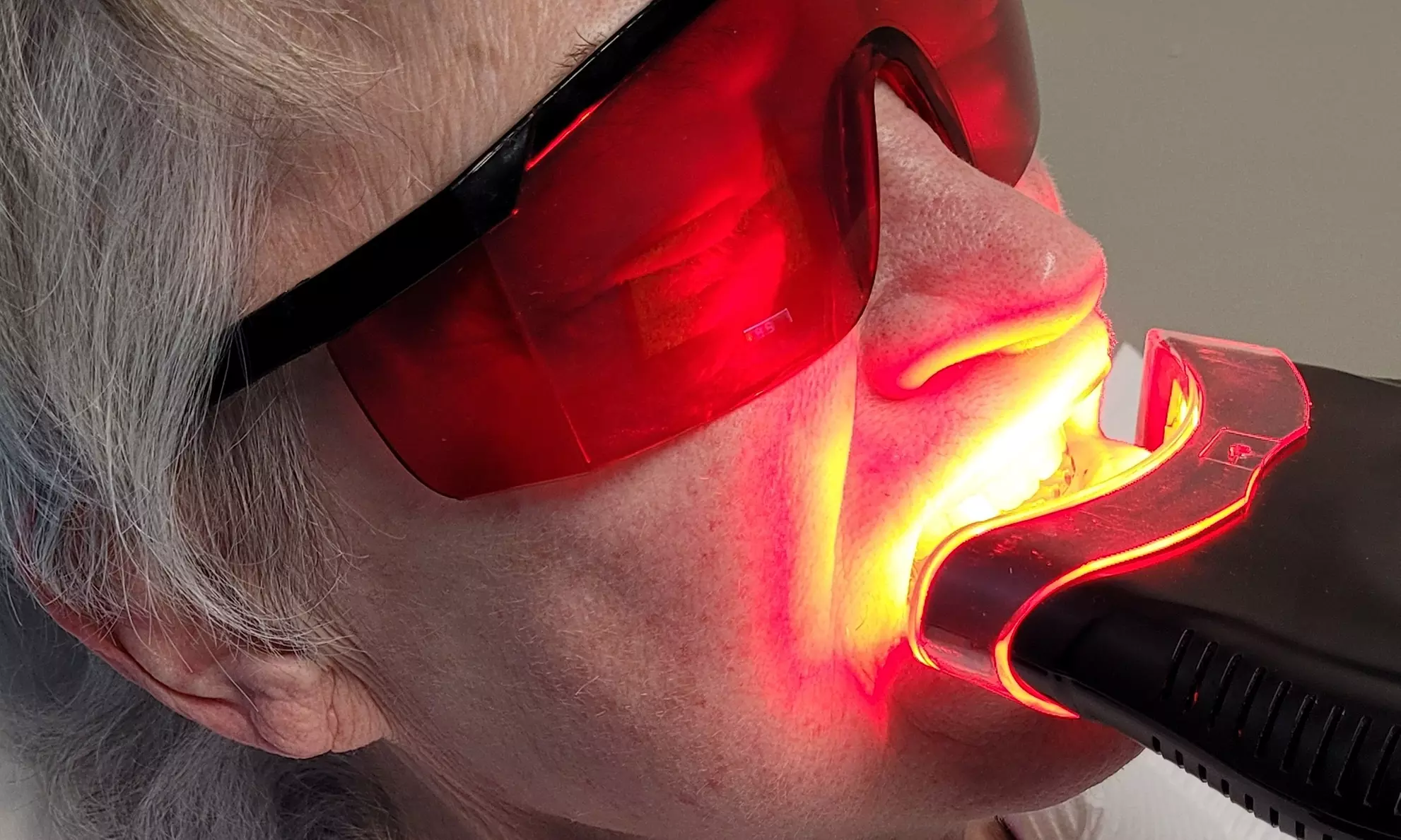 Experience teeth whitening with one session to enhance your smile