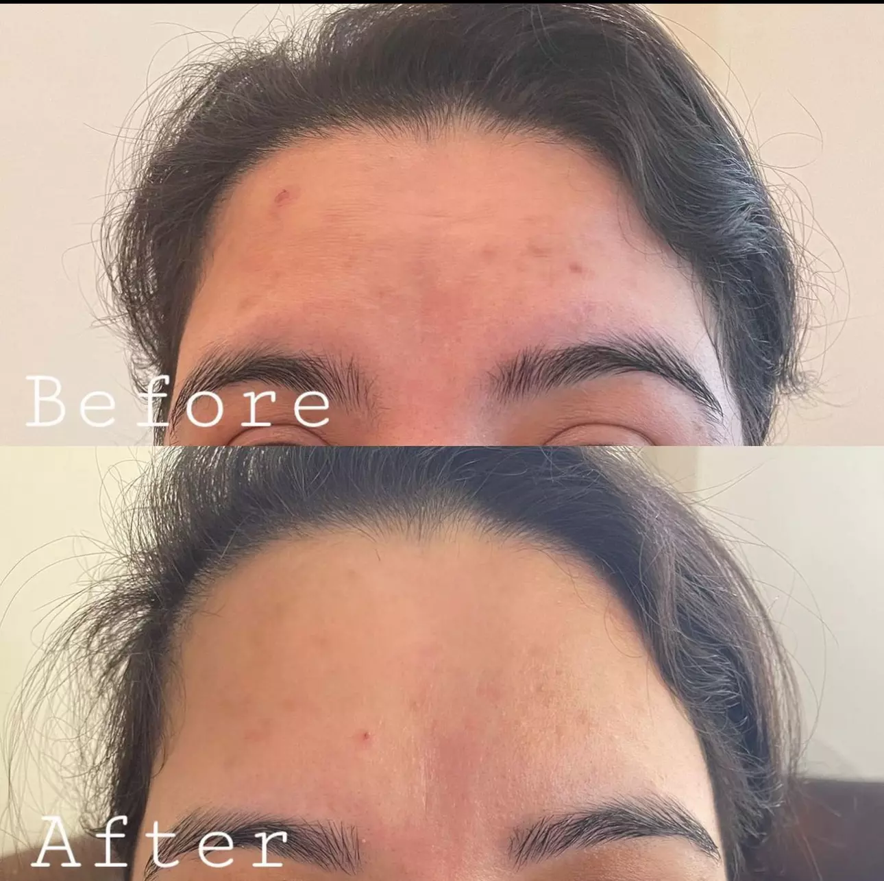 PRP / Platelet Rich Plasma / Vampire at Dr S Aesthetics