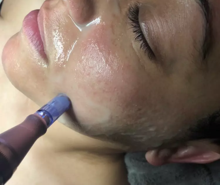 Up to 50% Off on Nano Infusion Nano Channeling at Skin Repair Studio wellness spa - Primary Image