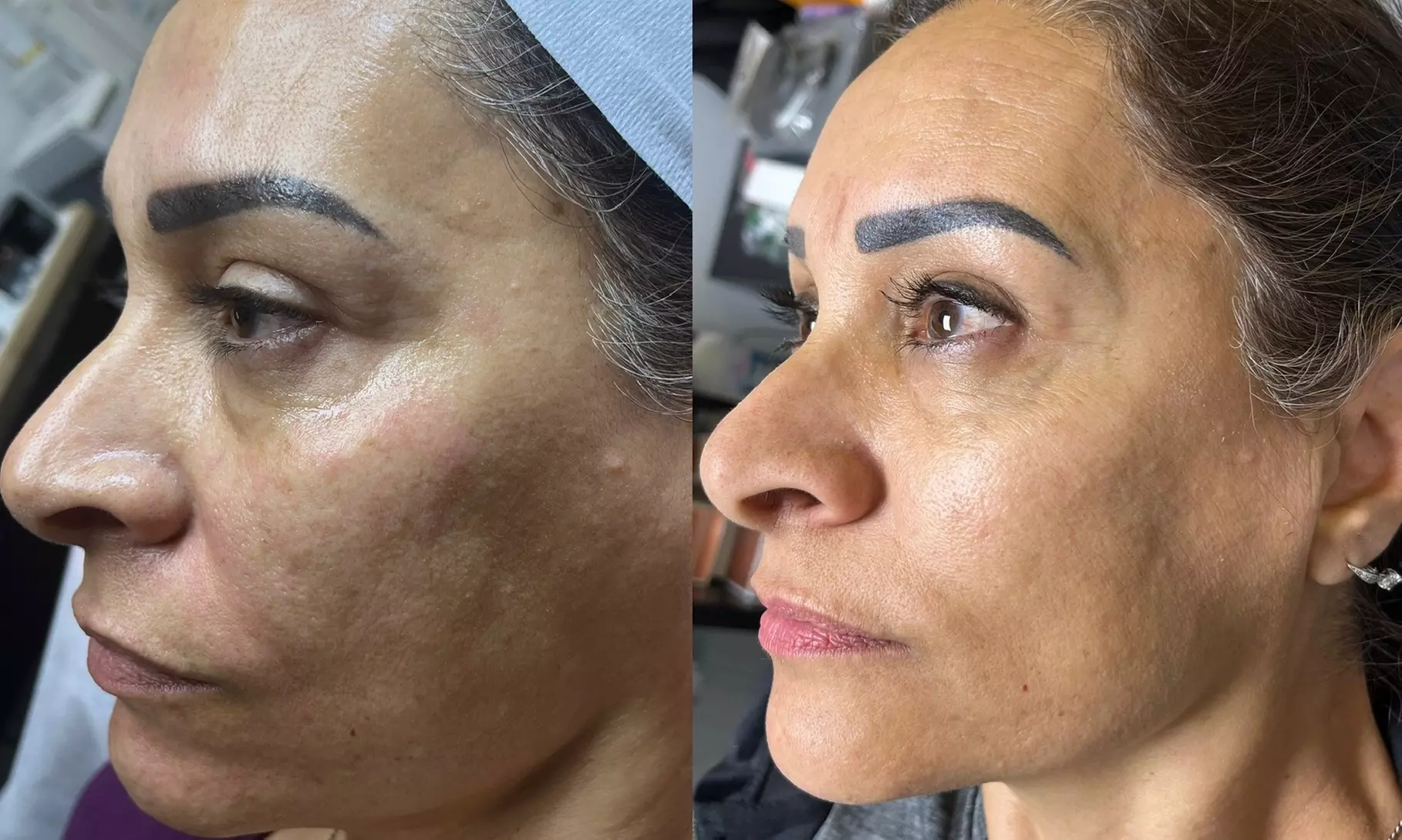 Transform Your Look With One or Two Micro-Needling Treatments