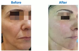 Up to 40% Off on Radio Frequency Skin Tightening at Zena Aesthetics