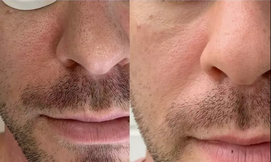 IPL acne, melasma, brown spots or rejuvenation treatment