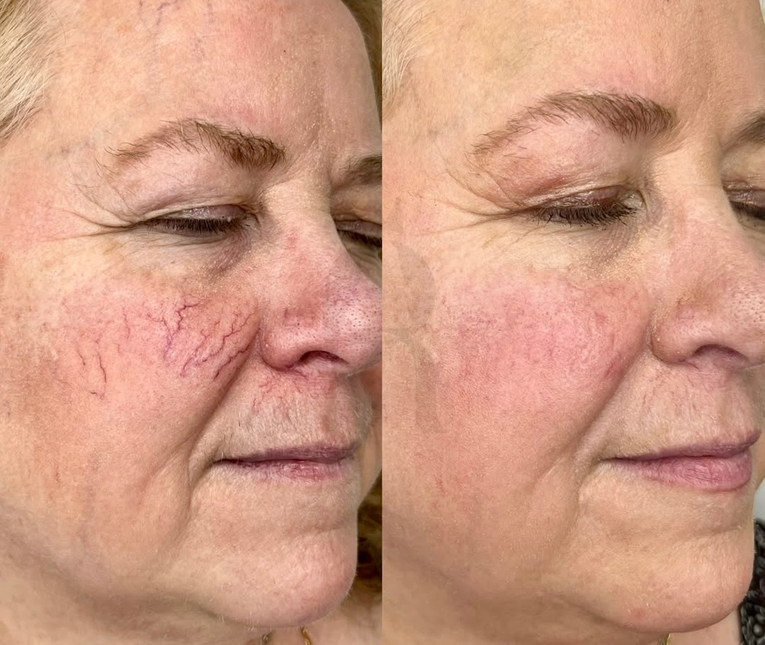 Advanced Thread Veins & Spider Naevi Removal Treatment for Face